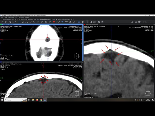 Raw DICOM in description, Foreign body on CT high bitrate, quality 20.11.2025