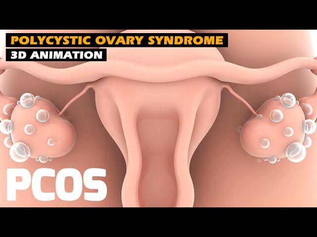 Polycystic Ovary Syndrome "PCOS" | 3D Animation