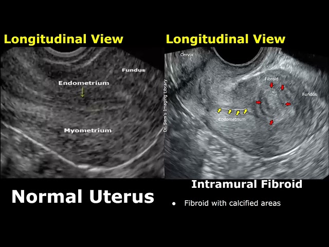 Uterus Ultrasound Normal Vs Intramural Fibroid Images | Uterine Leiomyomas USG Cases