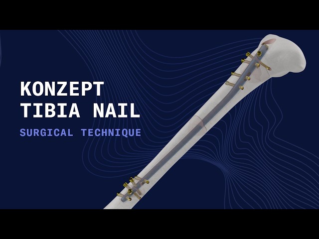 Auxein Konzept Tibia Nailing System | Advanced Intramedullary Fixation