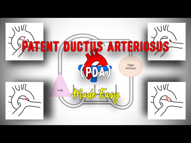 PDA • Patent Ductus Arteriosus • Anatomy • Pathophysiology • Clinical features • Made Easy
