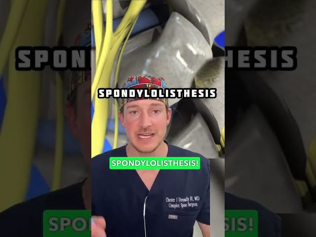 𝗦𝗹𝗶𝗽𝗽𝗲𝗱 𝗗𝗶𝘀𝗰? 𝗢𝗻𝗲 𝗼𝗳 𝘁𝗵𝗲 𝗰𝗮𝘂𝘀𝗲𝘀 (spine doc explaining)