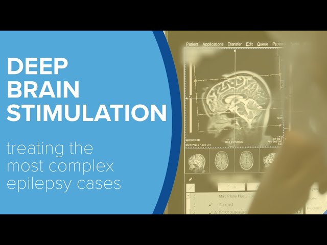 Deep Brain Stimulation For Epilepsy - Yale Medicine Explains