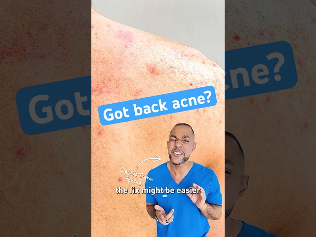 How to get rid of back acne