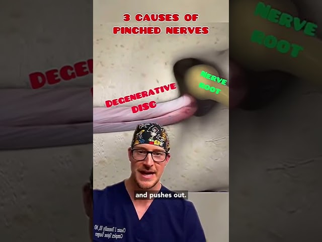 3 Causes of Pinched Nerves (explained by a spine surgeon) 🤓