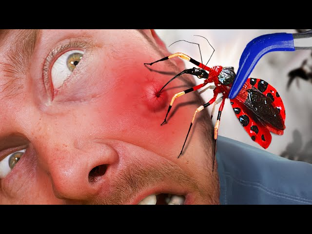 Bitten by Parasitic Assassin Bug! ( Sends Me to the Hospital)