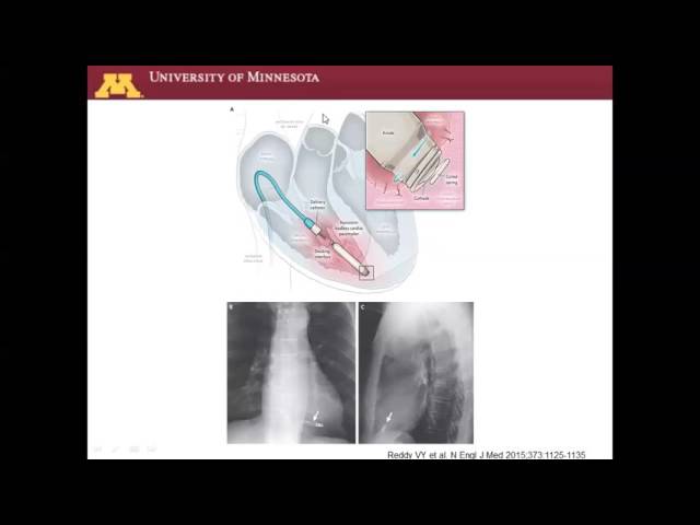 Late Breaking Trial - Leadless II
