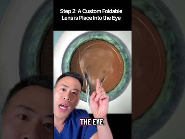 ICL vs LASIK Surgery. How to get rid of glasses #ophthalmology #optometry #lasik #icl #surgery