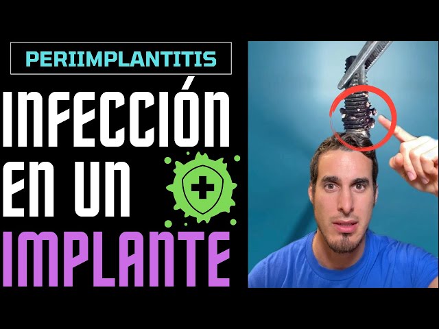 Si llevas IMPLANTES DENTALES esto te interesará - INFECCIÓN DE IMPLANTE o PERIIMPLANTITIS