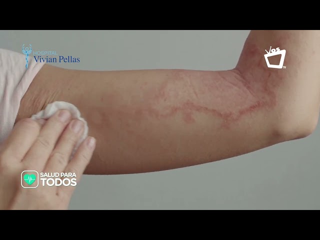 La lepra || SALUD PARA TODOS