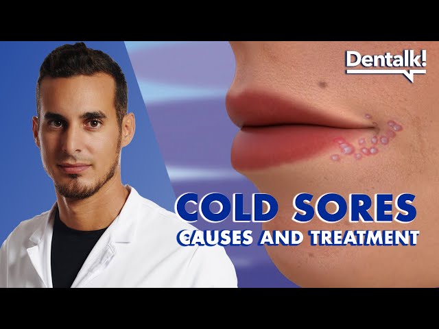 Do you have COLD SORES? TREATMENT and CAUSES of the herpes virus on LIPS | Dentalk! ©