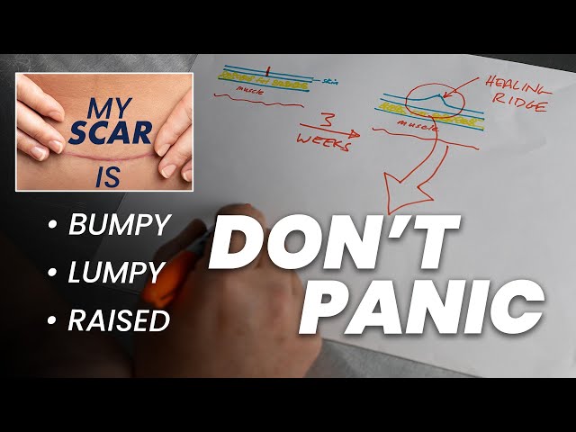 Battling Bumpy & Lumpy Incisions After Surgery | Healing Ridge