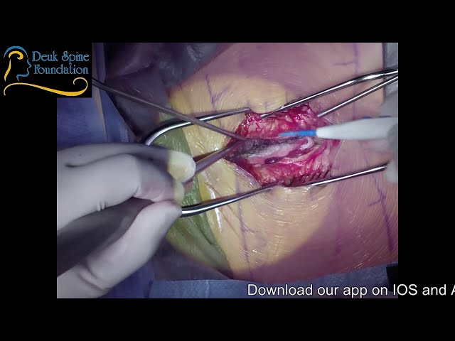 TLIF Lumbar Fusion Surgery L4-5 L5-S1, Live from the OR - Deuk Spine Institute