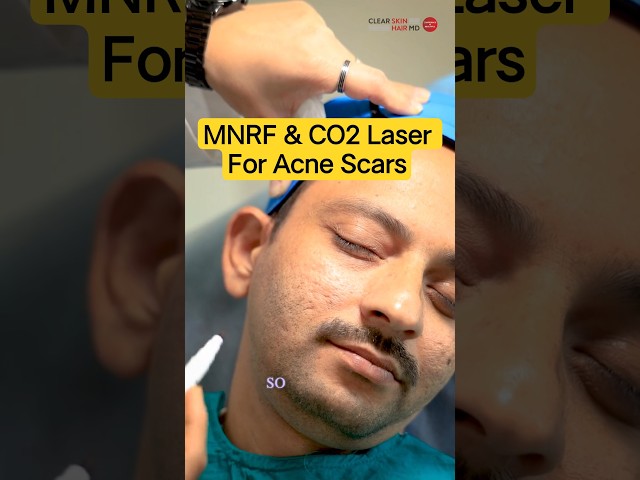 How MNRF And CO2 Laser Remove Acne Scars: Step By Step! | Clear Skin Clinic, Pune