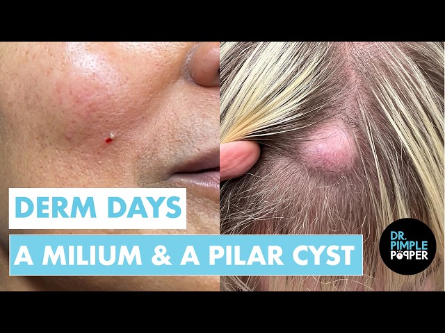 A Milium & A Pilar Cyst | Derm Days w/ Dr. Pimple Popper