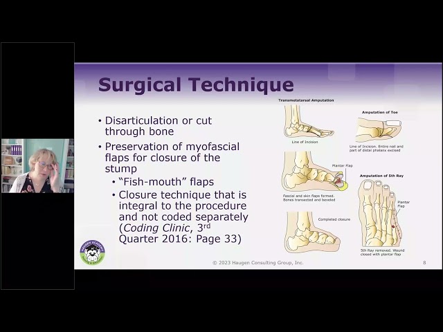 HCGTV: Webinar Snippet - Amputation Coding for PCS - Myofascial "Fish Mouth" Flaps