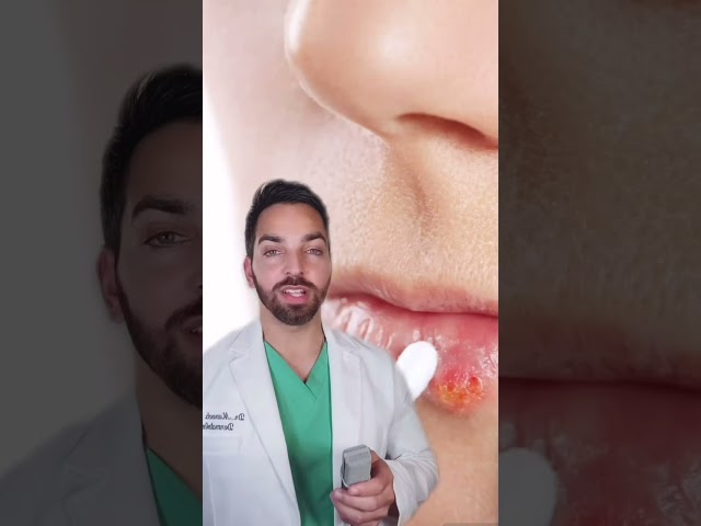 COLD SORES ON THE LIPS? #shorts