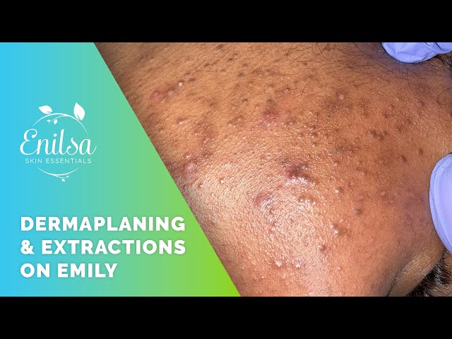 Light Dermaplaning + Blackhead Extractions on Emily