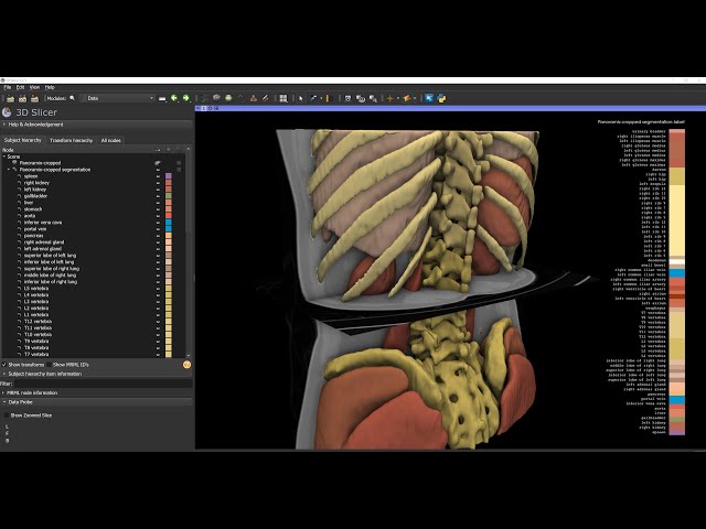 Automatic whole-body CT segmentation in 2 minutes using 3D Slicer and TotalSegmentator