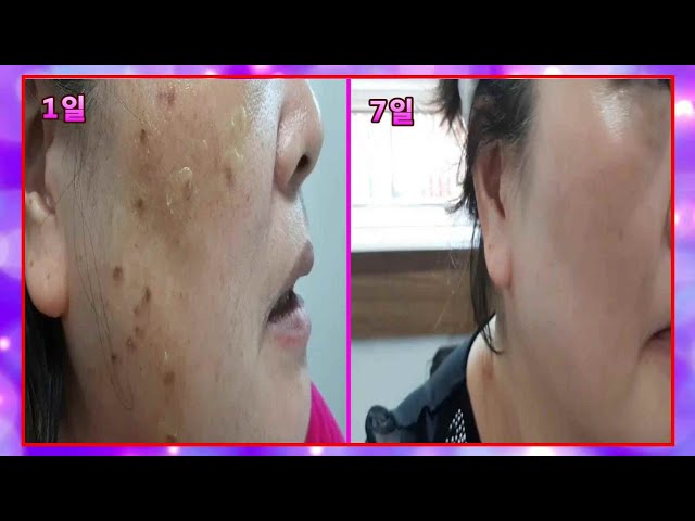 💖💥 점 빼기 후기 기록. 사후 관리 등등( 💖💥 A postscript to remove mole, Follow up management, etc )