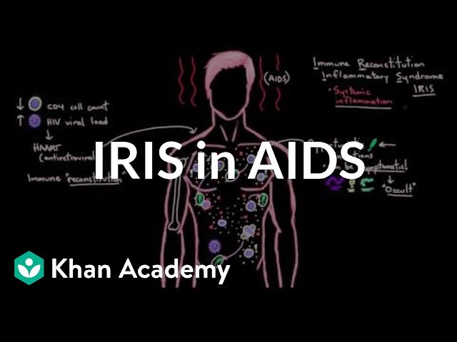 Immune reconstitution inflammatory syndrome (IRIS) in AIDS | NCLEX-RN | Khan Academy