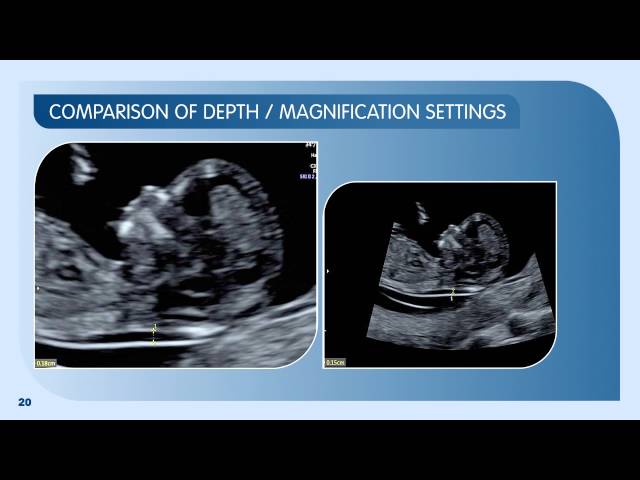 Measuring Nuchal Translucency and Crown Rump Length: 12–13 weeks scan