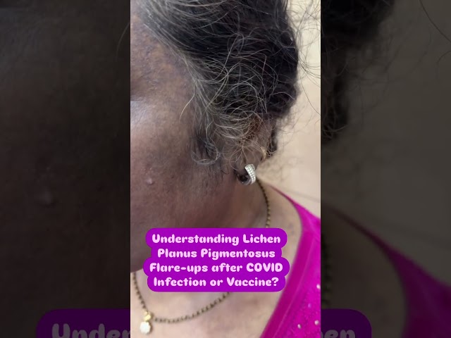 Why does LPP flare up after COVID infection or vaccination? Dr Ashima Goel MD Dermatologist  Punjab