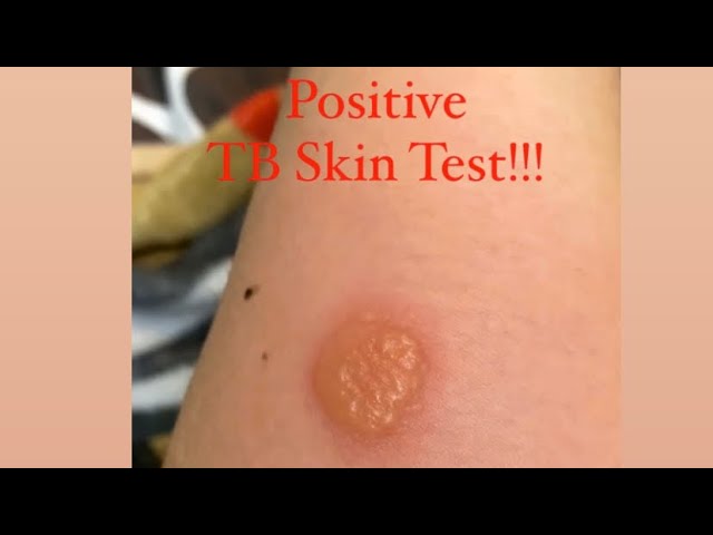 POSITIVE TB SKIN TEST!!!