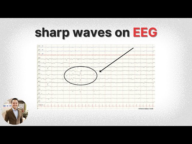 Learn EEG: Positive Spikes and Sharps