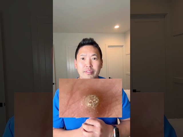 Plantar Warts Explained by a Dermatologist!