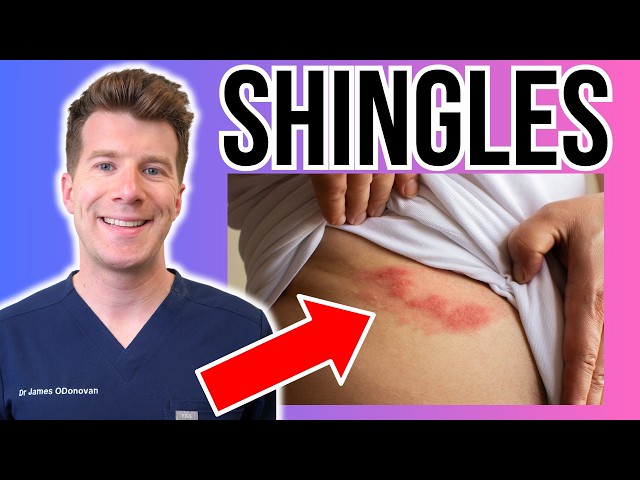 Doctor explains Shingles | Causes, rash, treatment, vaccine and more