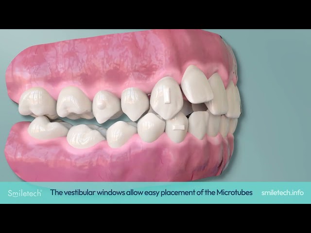 Smiletech Hybrid System