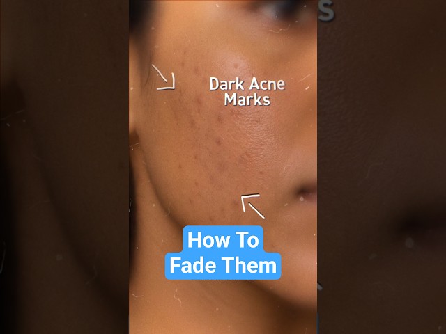 How to Fade Acne Marks!