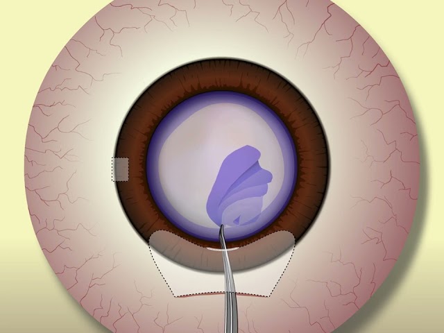 Surgery: MSICS for the Phaco Surgeon