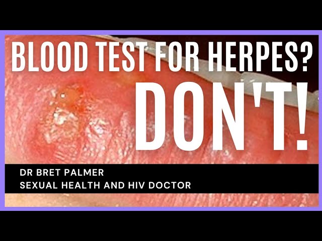 Should you do a herpes blood test? No, you shouldn't!