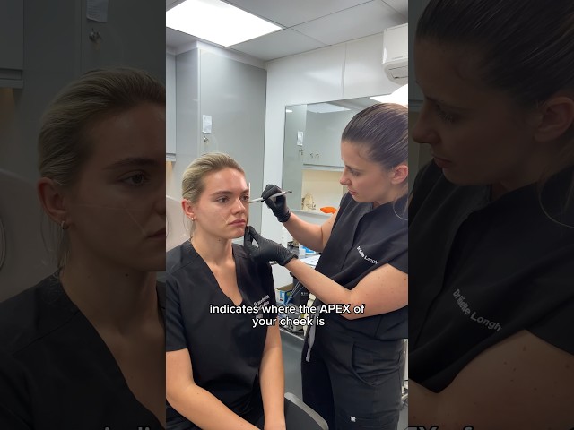 Cheek Filler To Enhance & Refine The Mid Face | Dr. MediSpa