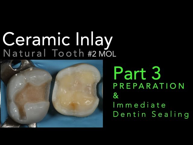 Lithium Disilicate Ceramics, Part  3: Preparation and Immediate Dentin Sealing (IDS)