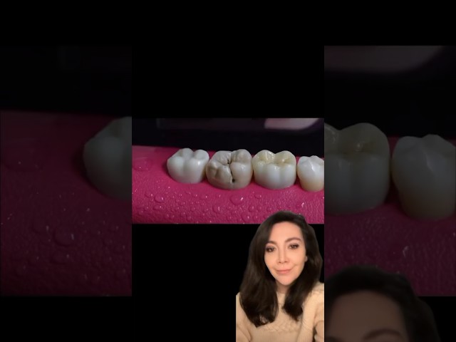 What Happens When you Need A Root Canal Treatment?!