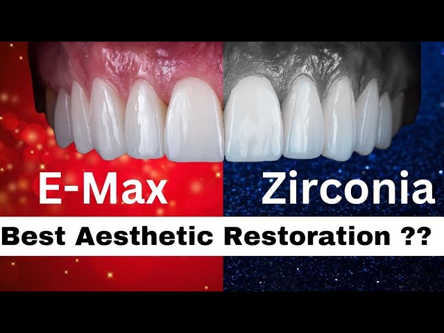 Best Material for Front Teeth Crowns: Emax vs. Zirconia | Durability, Aesthetics & Strength.