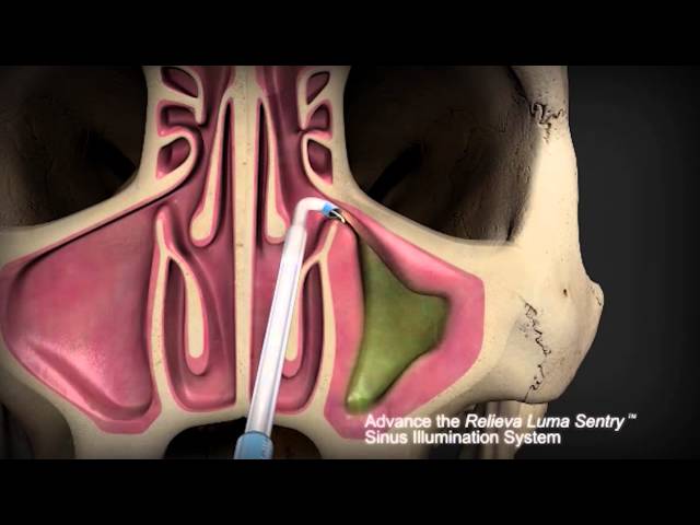 Balloon Sinuplasty vs.Traditional Sinus Surgery with ENT Dr. Timothy Ragsdale