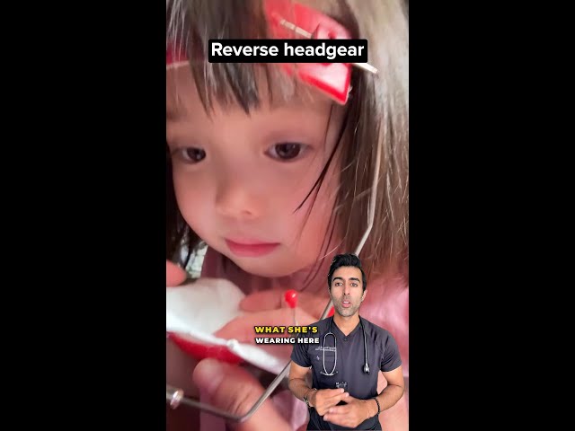 Reverse Headgear for Underbites: How a Protraction Facemask Works