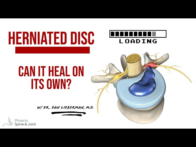 Can A Herniated Disc Heal?  WITHOUT surgery?!? 2023