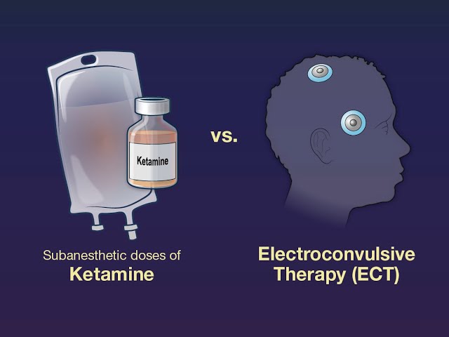 Ketamine vs. ECT for Major Depression | NEJM