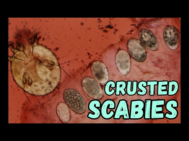 Crusted Scabies Under Microscope (Adult Mite, Eggs w baby mites inside, & poop) Skin Scraping Slide