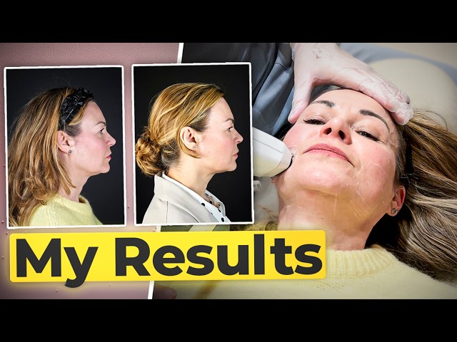 Is Sofwave A Non-Surgical Facelift? My 3-Month Results + Review