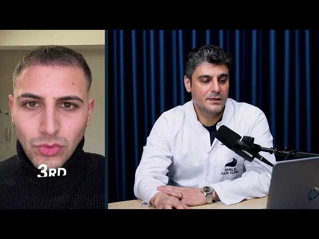4000 Grafts Hair Transplant | 12-Month Case Study by Dr. Gökay Bilgin