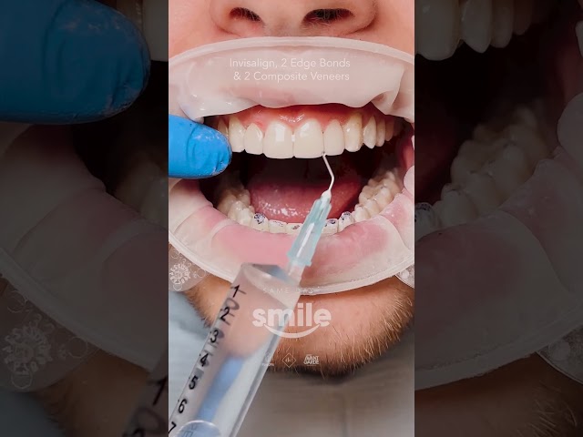 Invisalign with 2 composite edge bonding and 2 composite veneers by Dr Alex🤌🏼Simple yet effective 💯