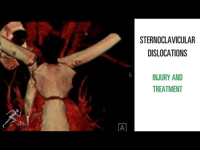SC dislocation: Mechanism of injury and treatment of a sternoclavicular dislocation