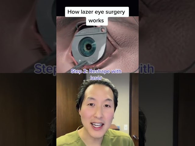 ¡Cómo funciona la cirugía ocular con láser LASIK! #shorts #lasik #cirugíaojolaser