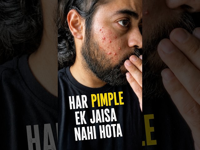 Har Pimple Alag Hota Hai! Types of Acne & Unka Solution (100% Working)